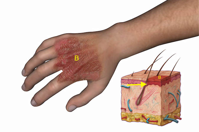 burns-hand-surgery-source